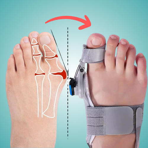 BunionFix™ - Natural At-Home Bunion Corrector